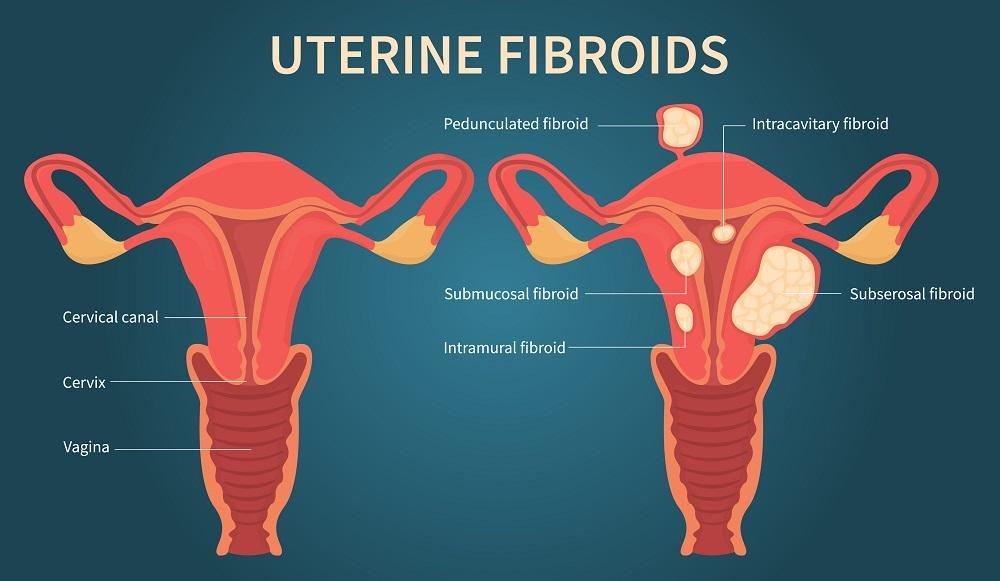 fibroids