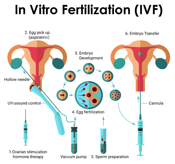 ivf-treatment